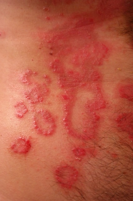 Psoriasis 