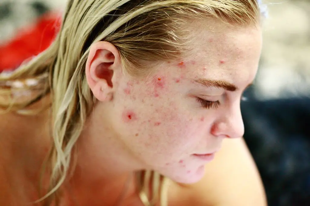 skin disorder: acne